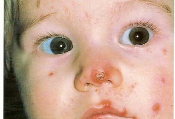 Pioderma nei bambini: cause, sintomi e cure
