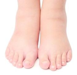 Gonflement des pieds. Causes et prévention