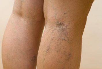 Krampfadern in den Beinen: die beste Behandlung – Prävention!