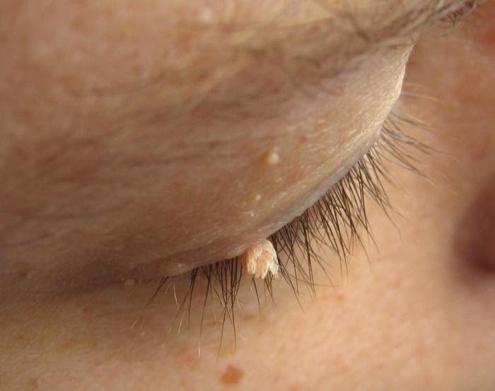 papillomi sulla pelle cause human papilloma virus survival outside body