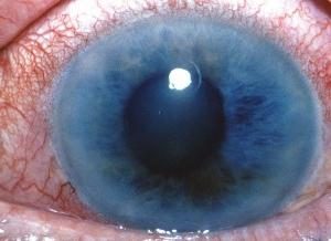 il trattamento del glaucoma al primo segno della malattia