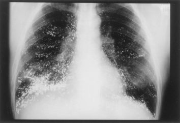 polmonite nosocomiale: gli agenti patogeni, trattamento e la prevenzione