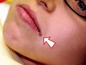 Nieżytowe zapalenie języka: jak leczyć zapalenie jamy ustnej u dzieci