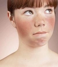 Perché viso rosso: cause e trattamento