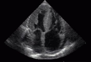 coração ecocardiografia: características deste inquérito e as indicações para a sua conduta