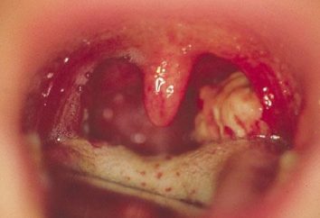 Qual è la tonsillite e quali sono i sintomi?