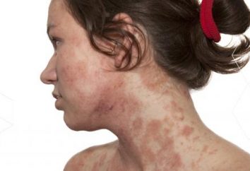 L'atopia – dermatite atopica è …