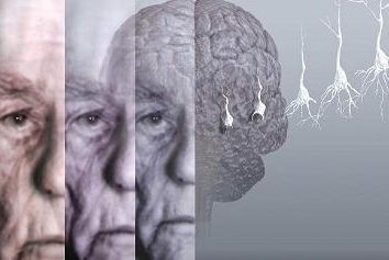 La sindrome di demenza o demenza