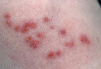 zoster Rose contagieuse ou non? Comment est pityriasis rosea?