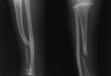 Pseudoartrose após fractura. joint falsa hip