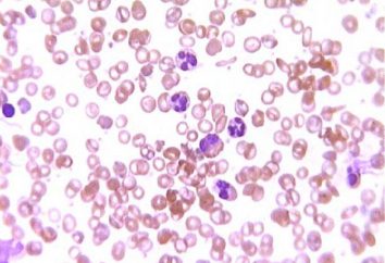globules blancs élevé dans le sang: quelle est la cause et quel est le traitement?