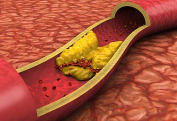 Dans l'artère plaques carotide: traitement. plaques de cholestérol: Causes, symptômes
