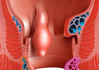 Anal pólipos no ânus: sintomas e tratamento