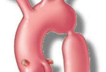 Coarctação da aorta – o que é isso? Coarctação da aorta em crianças