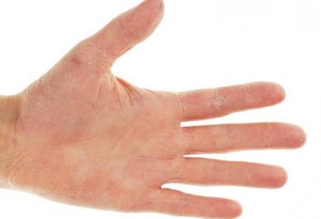 Rötungen und Juckreiz an den Händen und Füßen: die Behandlung