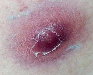 Ántrax – una inflamación purulenta-necrótica aguda de la piel: causas, tratamiento, prevención