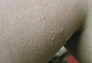 Brufoli sulle mani: il trattamento delle allergie invernali