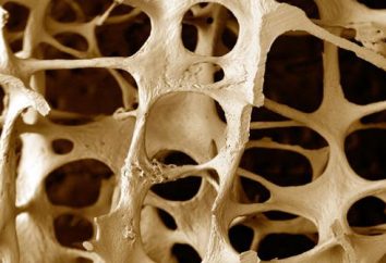 Osteoporose. Was ist das für Pathologie?