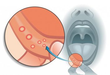 Aftas en la boca: las causas de la descripción y en particular el tratamiento