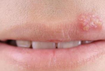 Brodawczaka usta: przyczyny, leczenie, usuwanie laserowe