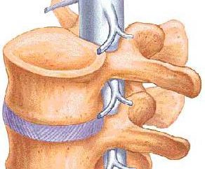 Rozszczep kręgosłupa – co to jest? Ostre zaburzenia kręgosłupa