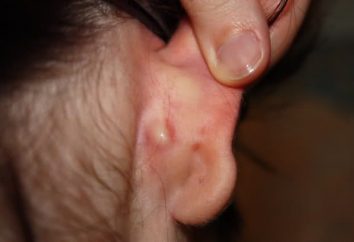 Ruchome guzki za uszami – co to jest?