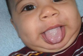 Thrush em um bebê: causas e sintomas