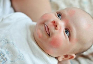 Wysypka u niemowląt: Zdjęcie, objawy i leczenie