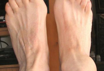 Sinovite dell'articolazione della caviglia: trattamento, recensioni, foto, motivi
