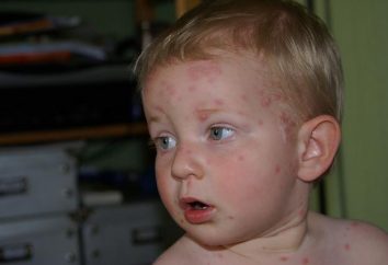 Come e come trattare il varicella in un bambino?