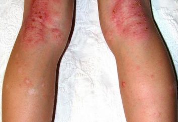 Dermatite sulle gambe: cause e trattamento