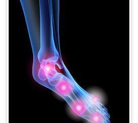 Artrite dell'articolazione del piede: cause, sintomi e trattamento