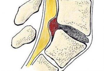 Hernie dorsale du disque: quelle est la classification et les caractéristiques du traitement