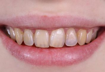Erosione dentale: descrizione, le cause, i sintomi e le caratteristiche del trattamento