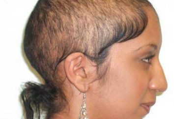 C'è una cura alopecia androgenetica? Cause di perdita di capelli. trapianto di capelli