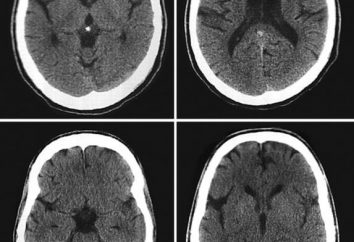 tomographie assistée par ordinateur du cerveau: les procédures d'examen