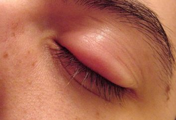 Come rimuovere il gonfiore agli occhi? Semplici passi per un aspetto luminoso