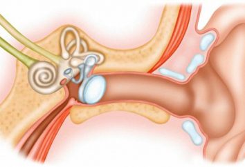 O plugue no ouvido: os sintomas, maneiras para remover