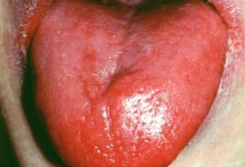 Typische Symptome von glossitis
