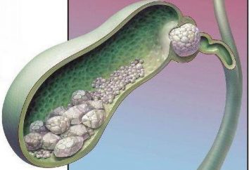Las piedras en los conductos biliares: Causas, síntomas y tratamiento