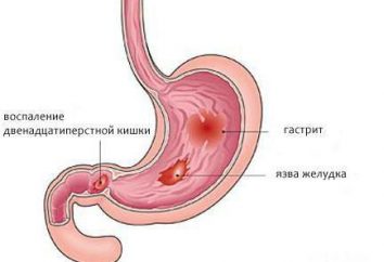 Infiammazione delle 12 ulcera duodenale: cause e trattamento
