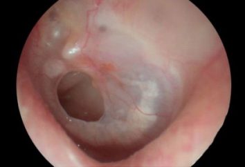 úlcera perfurada: sintomas e tratamento