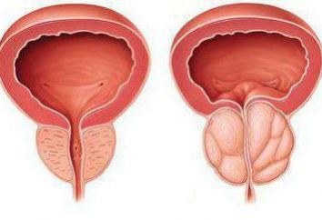 La diagnosi di prostatite negli uomini – è necessario sapere?