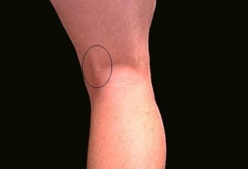 Schmerzen hinter dem Knie von hinten – Ursachen