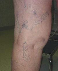 veines visibles dans les jambes – la cause des varices?