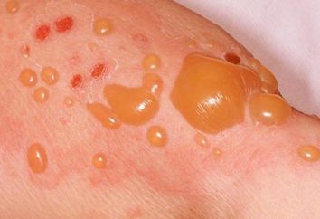 dermatite bulleuse: les causes, les symptômes, le diagnostic et le traitement