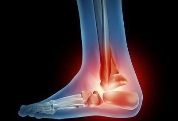 Osteoartrite dos tornozelos: causas, diagnóstico, prevenção, tratamento