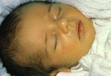 La ictericia en el recién nacido: Causas, síntomas y tratamiento