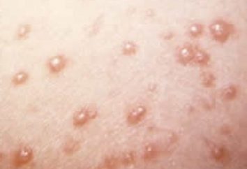 La varicelle traitement chez les enfants en Russie et à l'étranger?