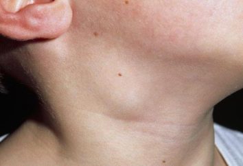 linfonodo inchado no pescoço: Causas e Tratamento